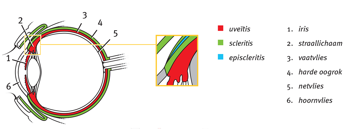 Uveïtis en scleritis