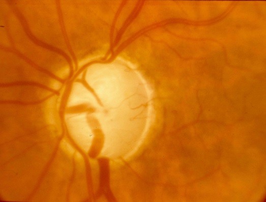 Foto van de oogzenuw aan de binnenkant van een oog met ernstig glaucoom (dit oog is bijna blind)