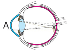 Cilinderafwijking (astigmatisme)