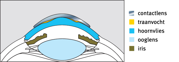 Contactlens bij hoornvliesafwijkingen