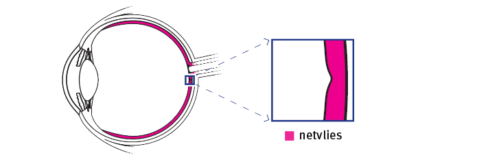 Doorsnede van het oog, waarbij wordt ingezoomd op de macula