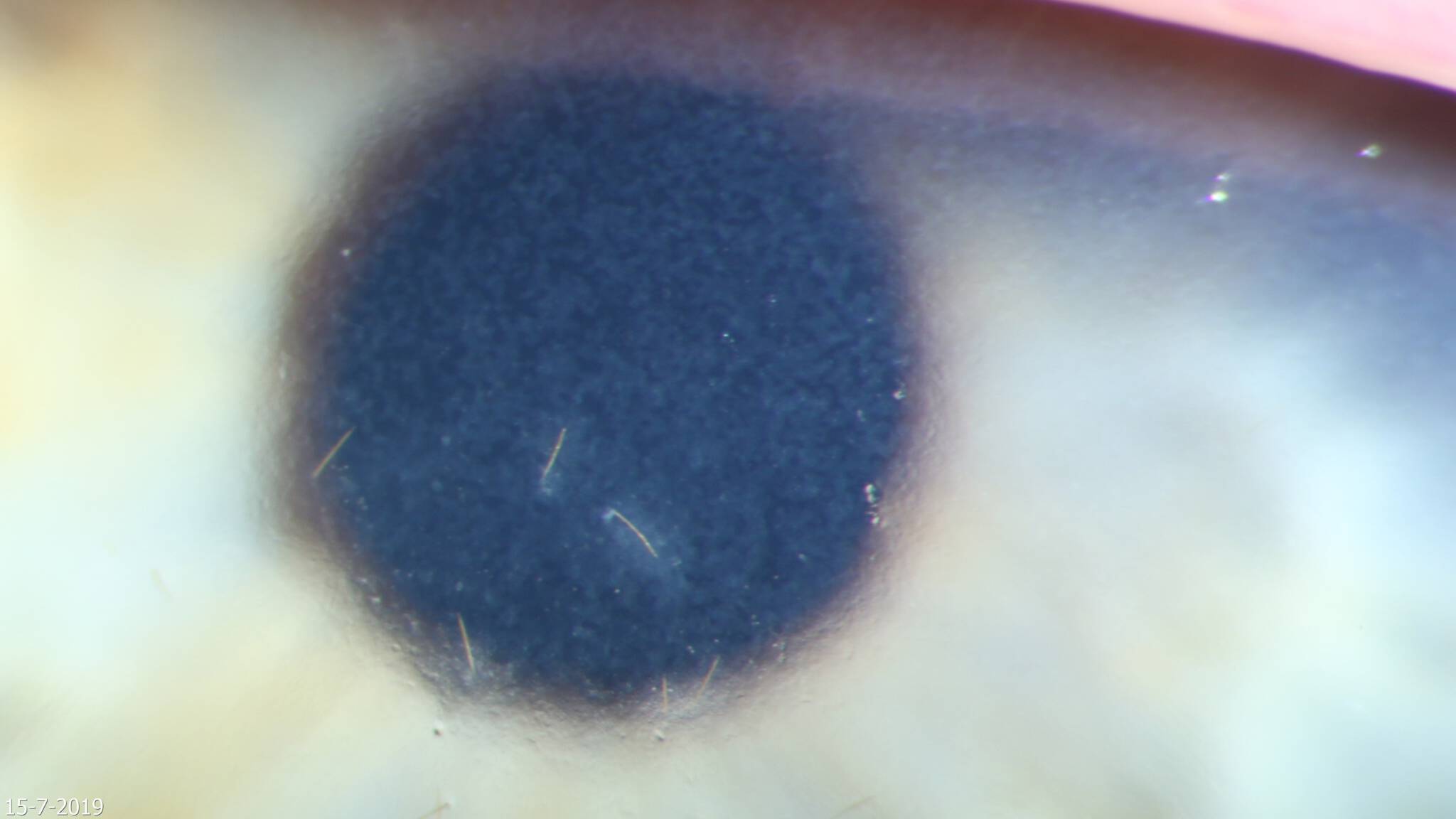 Haartjes van een eikenprocessierups in het oog van een meisje van 12
