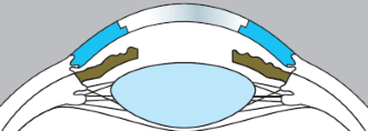 Anterieure Mushroom Penetrerende Keratoplastiek (AMPK)