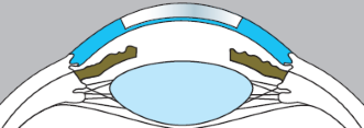 Diepe Anterieure Lamellaire Keratoplastiek (DALK)