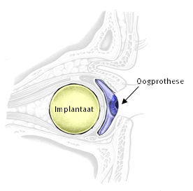 Implantaat (bolletje van kunststof) en oogprothese