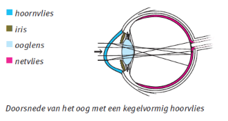 Kegelvormig hoornvlies (keratoconus)