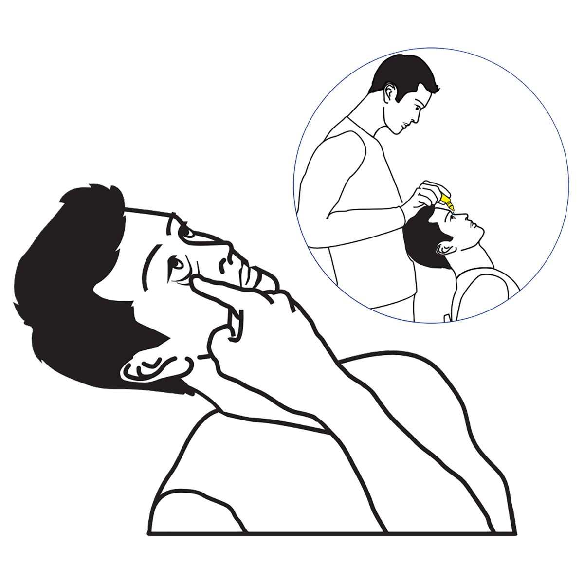 3. Laat de patiënt een gootje maken door met de wijsvinger het onderste ooglid naar beneden te trekken. Eventueel kunt u dit doen met de duim van uw andere hand. Steun met uw hand op het hoofd van de patiënt en houd het flesje boven het oog.