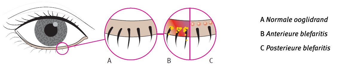 Uitleg blefaritis