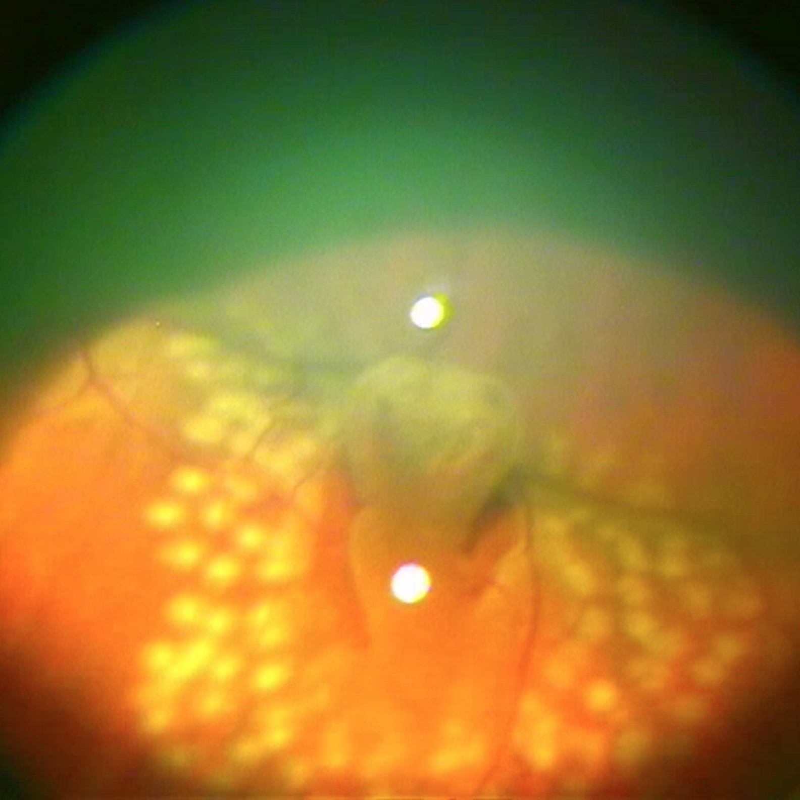 Meerdere kleine brandpuntjes in het netvlies bij een laserbehandeling bij scheurtjes in het netvlies.