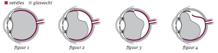 Netvlies en glasvocht