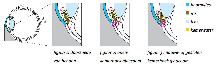 Open-, nauwe- of geslotenkamerhoekglaucoom