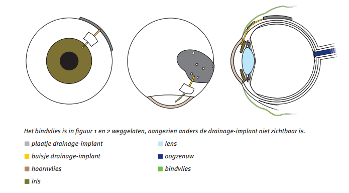 Glaucoomoperatie met Baerveldt-implant