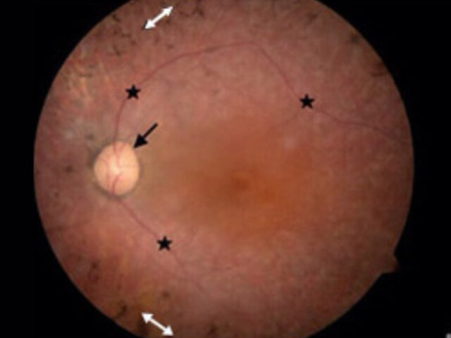 Netvlies aangedaan door syndroom van Usher
